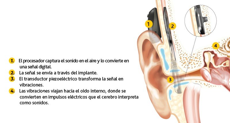 Diagrama: cómo funciona el sistema de conducción ósea